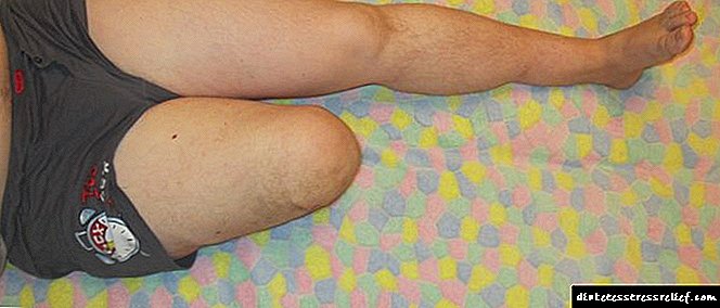 Diabetdə ayağın amputasiyası