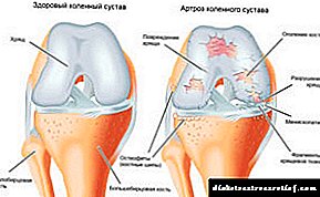 Uzroci, simptomi i liječenje artroze koljena