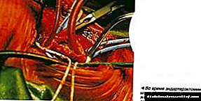 கரோடிட் தமனியில் பெருந்தமனி தடிப்புத் தகடு: செயல்பாட்டின் செயல்பாடு மற்றும் செலவு