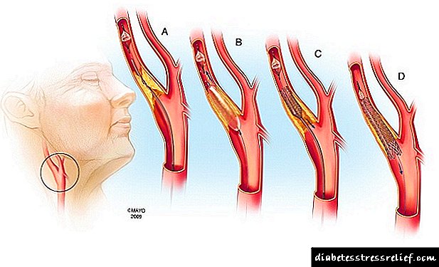 ဘယ်လို carotid arteriosclerosis ထင်ရှားသလဲ?