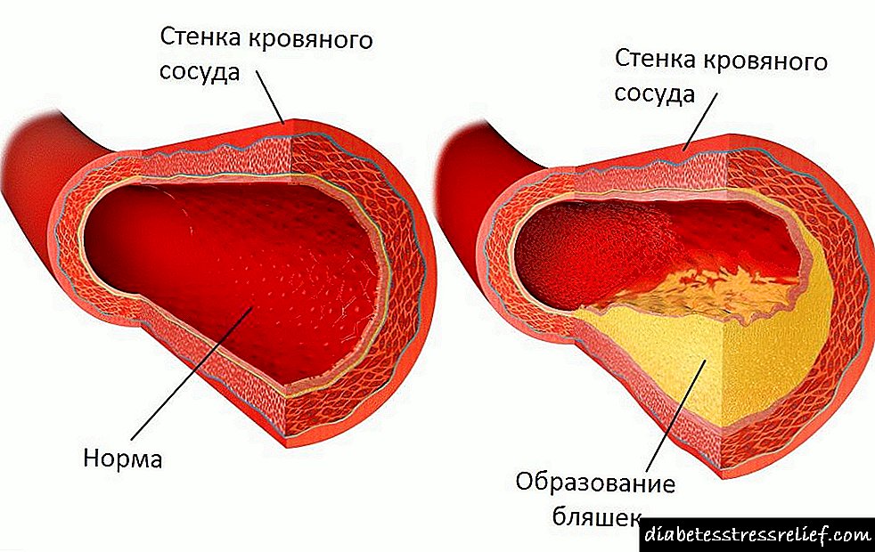 Как проверить сосуды на тромбы и холестериновые. Образование артериальных бляшек.