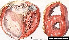 Atherosclerotic cardiosulinosis: kalafo, lisosa, thibelo