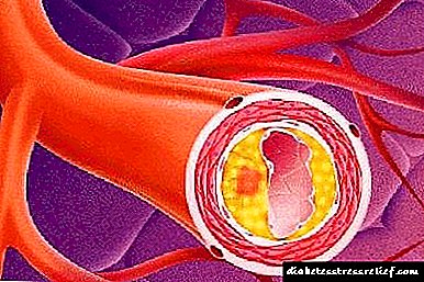 Atherosclerotic тактасындагы минералдаш-: бул эмне, түзүү жана дарылоонун пайда
