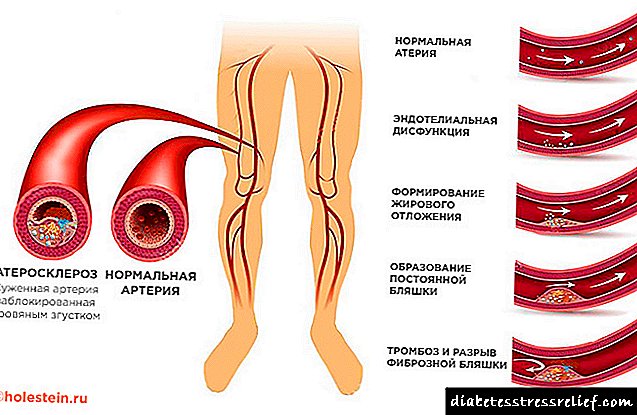 Aterosklerose van die onderste ledemate: ICD-10-kode, oorsake, simptome, diagnose en behandelingsmetodes