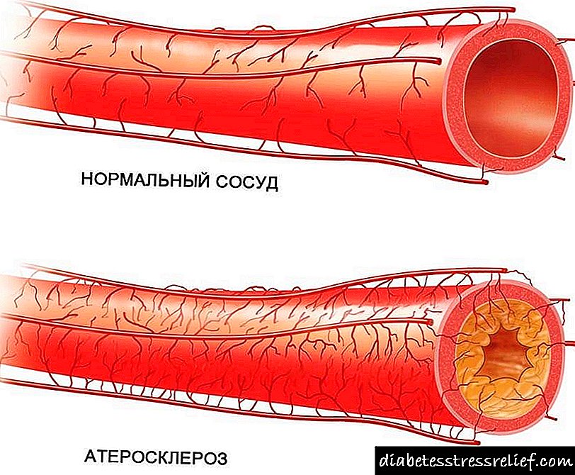 Garun arteriosklerosia