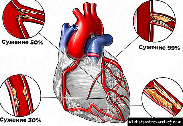 Aterosclerose dos vasos sanguíneos do corazón - ¿Cal é o perigo?