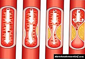 Kako očistiti krvne žile od holesterola narodnim lijekovima