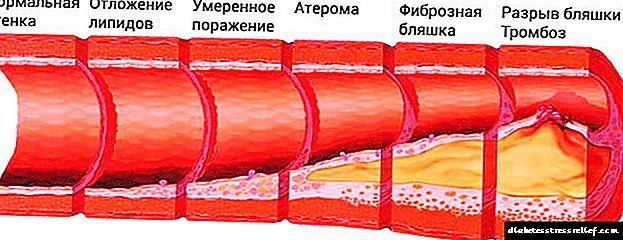 Aorta aterosklerozi: davolash va hayot uchun qanday prognoz
