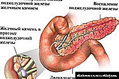 İnduktiv sklerozan pankreatit