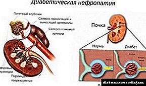 Microangiopathy katika ugonjwa wa sukari