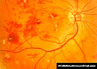 Диабетикалык ретинопатия: белгилери этап дарылоо