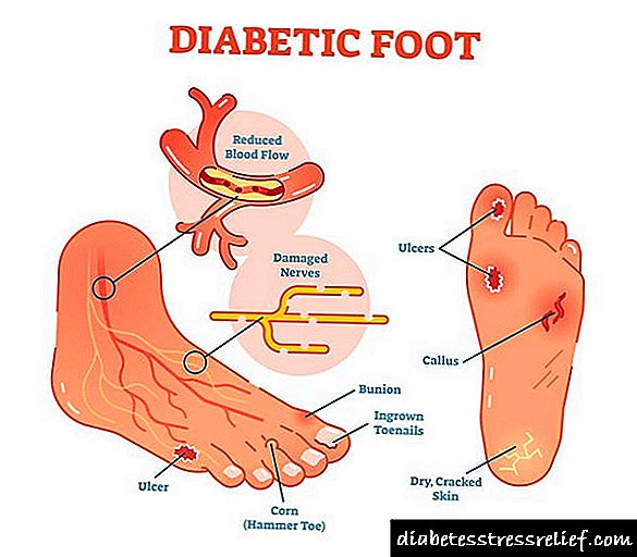 Diabetik ayaq: simptomlar, müalicə və qarşısının alınması