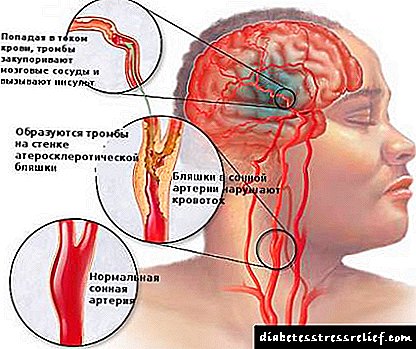 Mga gamot para sa paggamot ng cerebral arteriosclerosis