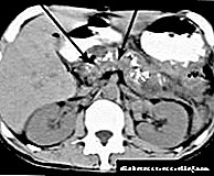 Pancreatic fibrosis