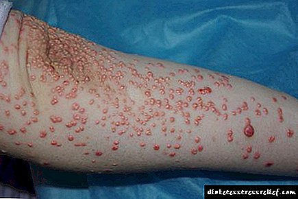 Foto ruam kulit kanthi diabetes lan liya kanggo perawatan