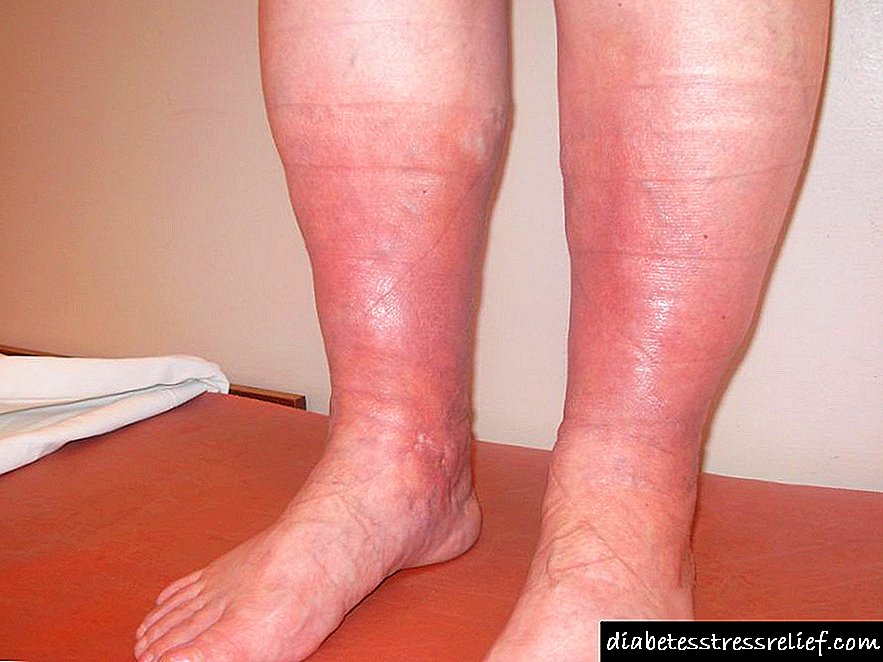 Gangrena (nekroza) nogu kod dijabetesa - simptomi i liječenje