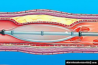 Sistemli və ya ümumiləşdirilmiş ateroskleroz