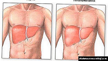 Que é a hepatomegalía do fígado: síntomas, dieta