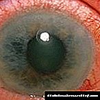 Ang glaucoma sa diabetes: hinungdan sa paglambo, pagtambal, operasyon