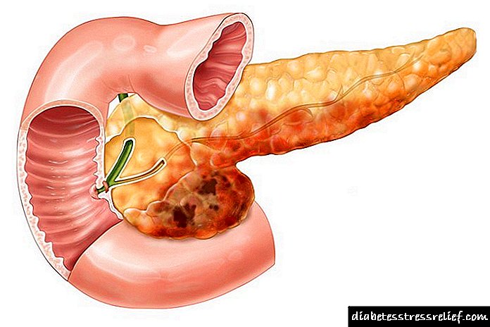 Ang pancreatic insulinoma (sanhi, palatandaan, pamamaraan ng paggamot)