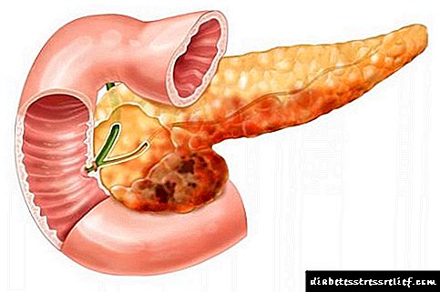 Pancreatitis Attack (Pancreas)