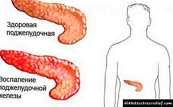 Pankreatit üçün enterosgel