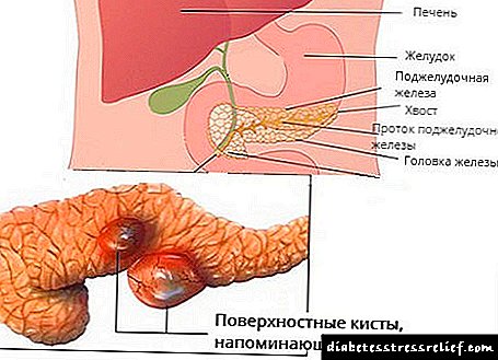 Cara ngobati polip ing pankreas