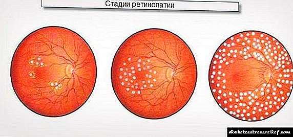 Diabetik retinopatiya