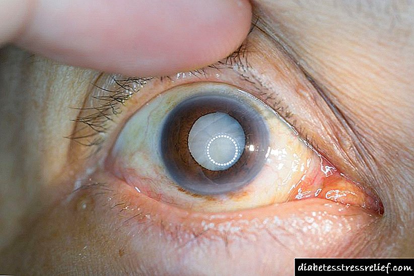 Symptomau cataract diabetig
