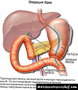 Pankreasna nekroza pankreasa