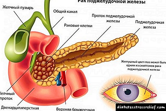 Pancreaticum cancer curatio capitis