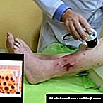 Prinsip pengobatan borok kaki piér di diabetes dina tahap-tahap patologi anu béda