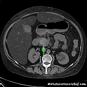 Слика од магнетна резонанца на панкреасот