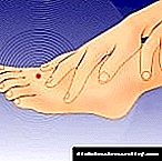 Нума на прстите и нозете кај дијабетес