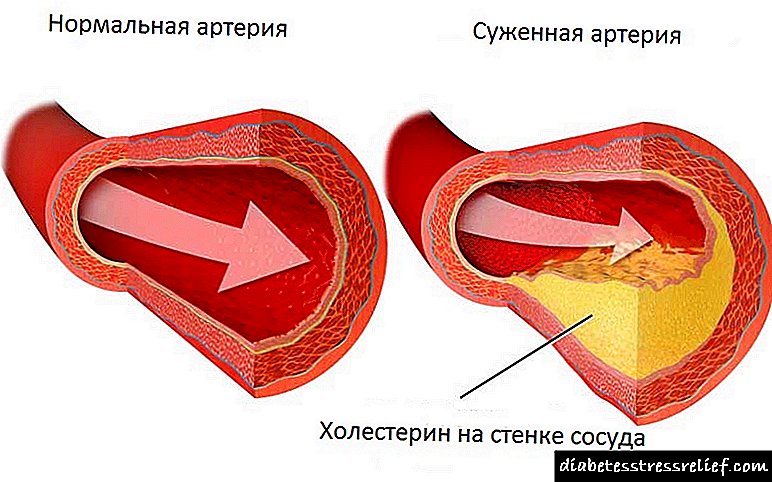 Efekti i diabetit në funksionin e zemrës