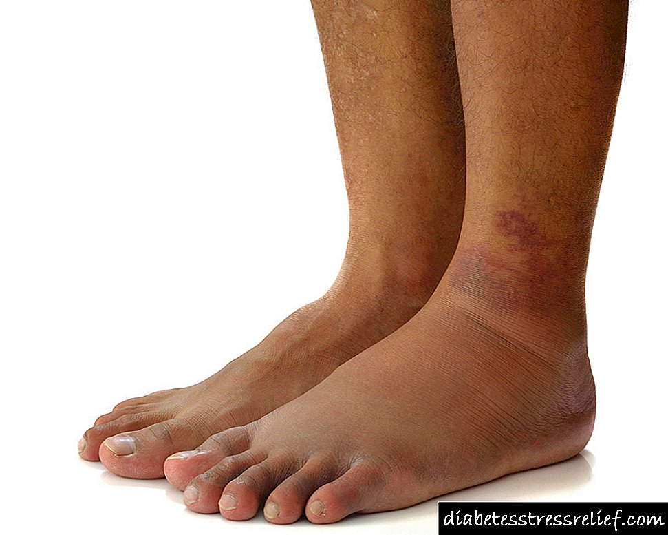 Oticanje nogu kod dijabetesa: mogući uzroci i značajke liječenja