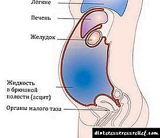 Pancreatitis na ascites