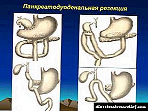 Pancreatoduodenal resection