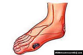 ფეხების ჭრილობების არაჯანსაღი მკურნალობა დიაბეტით