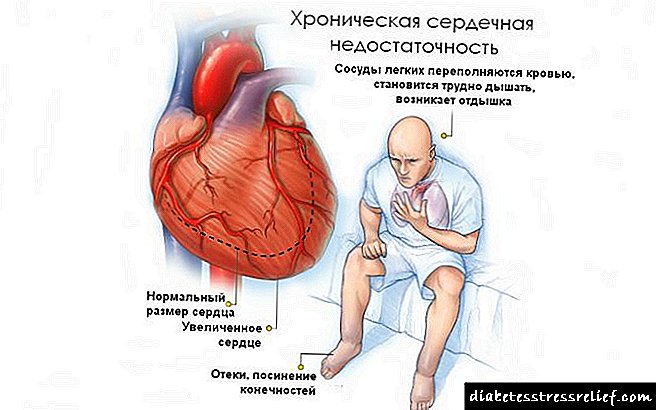 Кардиосклероза на пост-инфаркт