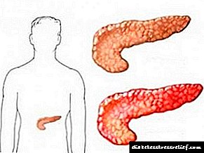 Ang pancreas ay pinalaki: sanhi, sintomas at paggamot