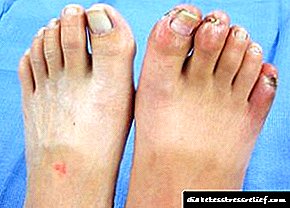 Mga timailhan ug pagtambal sa leg gangrene sa diabetes sa pasiunang yugto ug kasunod