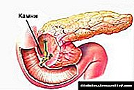 Pancreatitis: mga sintomas at sanhi ng sakit sa pancreatic