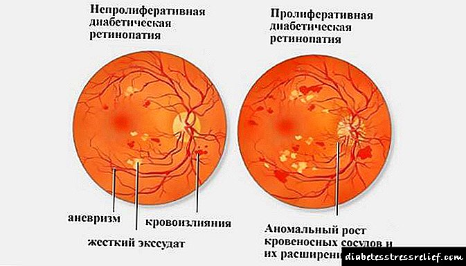 Аломатҳо ва табобати ретинопатия дар диабети қанд