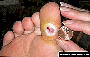 თანამედროვე შეხედულება ფეხის დაზიანების მკურნალობაში დიაბეტით დაავადებულებში