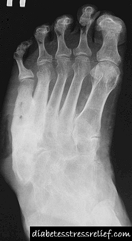 Charcotovo stopalo kod dijabetesa: liječenje, prvi znakovi i prevencija