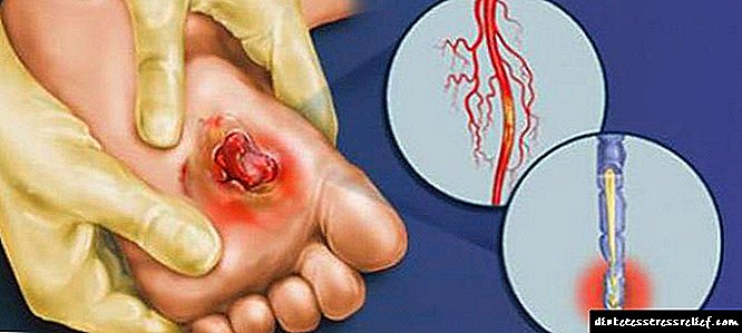 Charcot ayağı nədir: diabet xəstəliyinin əlamətləri və əlamətləri