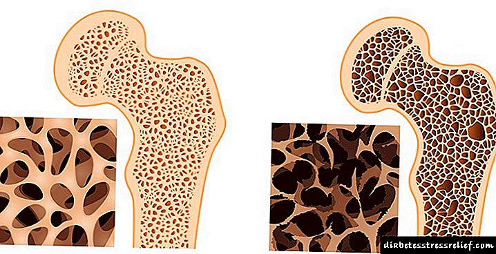Učinak dijabetesa na koštano tkivo: česti prijelomi i metode njihovog liječenja