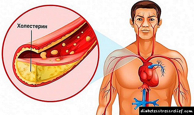 Ĉio Pri Alta Kolesterolo: Kion ĝi signifas, Kaŭzoj, Simptomoj kaj Traktado