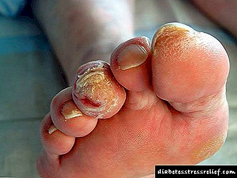 زخم های انگشتان پا برای دیابت